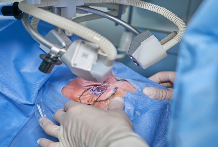 okulistyczny zabieg chirurgiczny